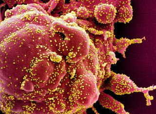 Colorized scanning electron micrograph of an apoptotic cell (red) infected with SARS-COV-2 virus particles (yellow), also known as novel coronavirus, isolated from a patient sample. Image captured at the NIAID Integrated Research Facility (IRF) in Fort De
