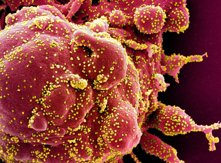 Colorized scanning electron micrograph of an apoptotic cell (red) infected with SARS-COV-2 virus particles (yellow), also known as novel coronavirus, isolated from a patient sample. Image captured at the NIAID Integrated Research Facility (IRF) in Fort De